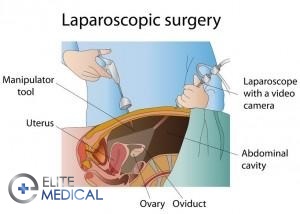laparoskopic